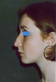 Chirurgia Estetica - Rinoplastica - foto prima dopo.